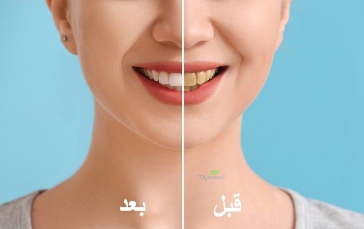 Quantum lentes dentales constant in Arabia Saudiana?