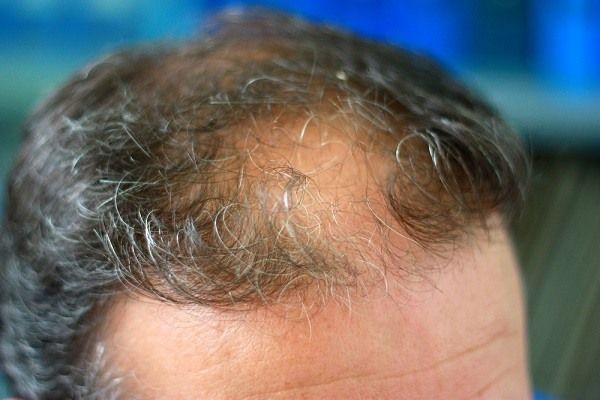 بعص الامراض تسبب مشكلة الشعر الخفيف