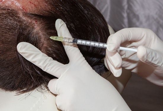 طريقة عمل الميزوثيرابي في معالجة الشعر