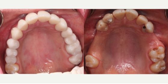 ⁨⁨‎⁨نتائج تجربتي مع زراعة الاسنان في جدة⁩⁩⁩