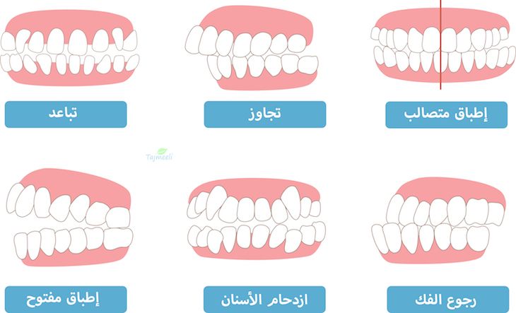 ⁨‎⁨مشاكل الفك العلوي والأسنان العلوية⁩⁩