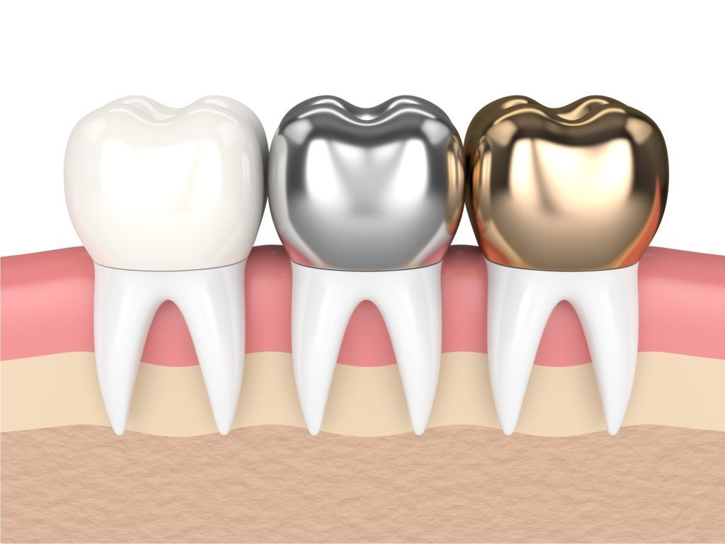 تركيبات الاسنان الاصطناعية الثابتة