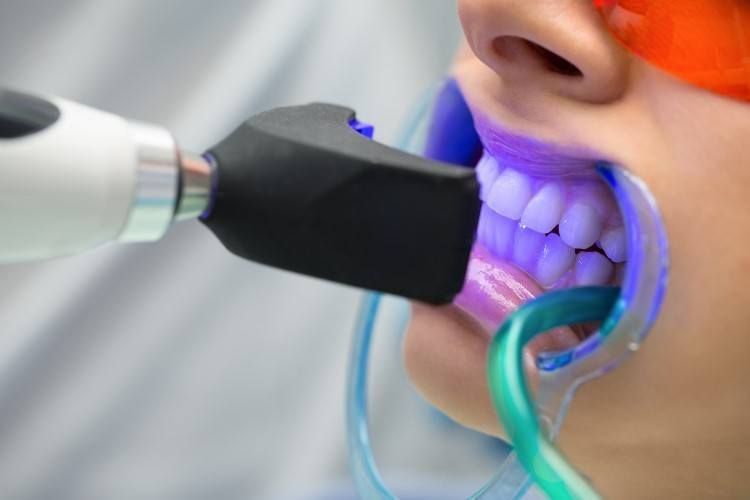 تبييض الاسنان الاصطناعية