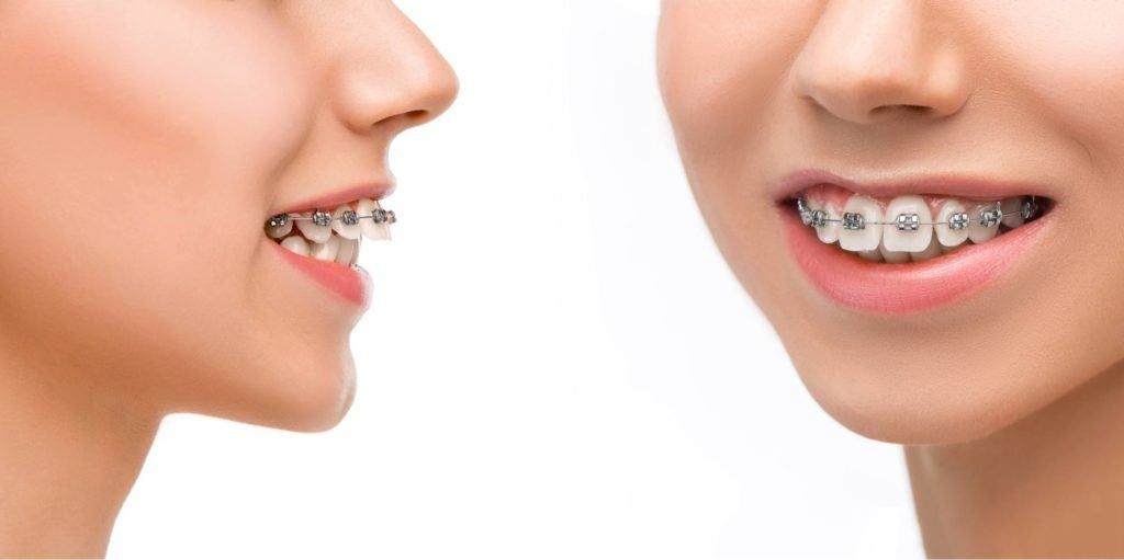 جراحات تعديل الأسنان البارزة 