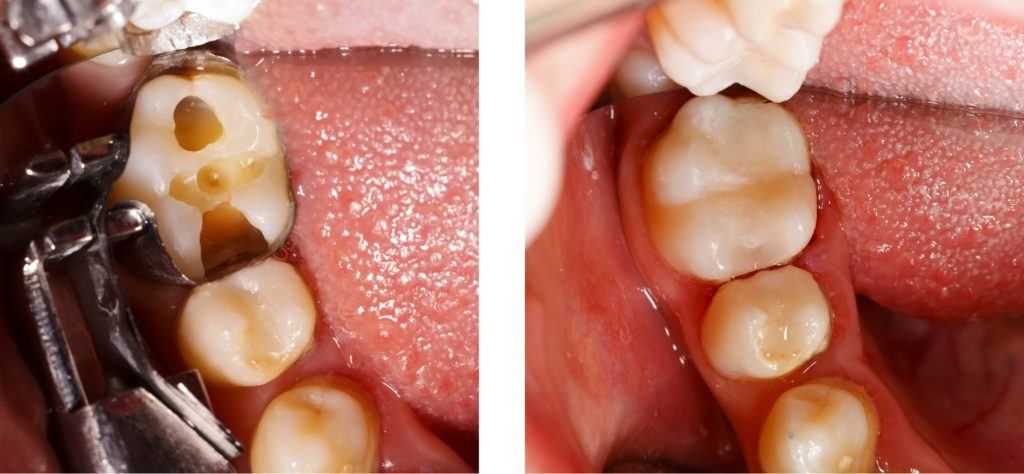 ما هي مميزات علاج تآكل الأسنان