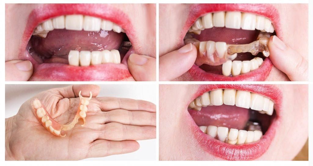 خطوات عملية تركيب الاسنان الامامية 