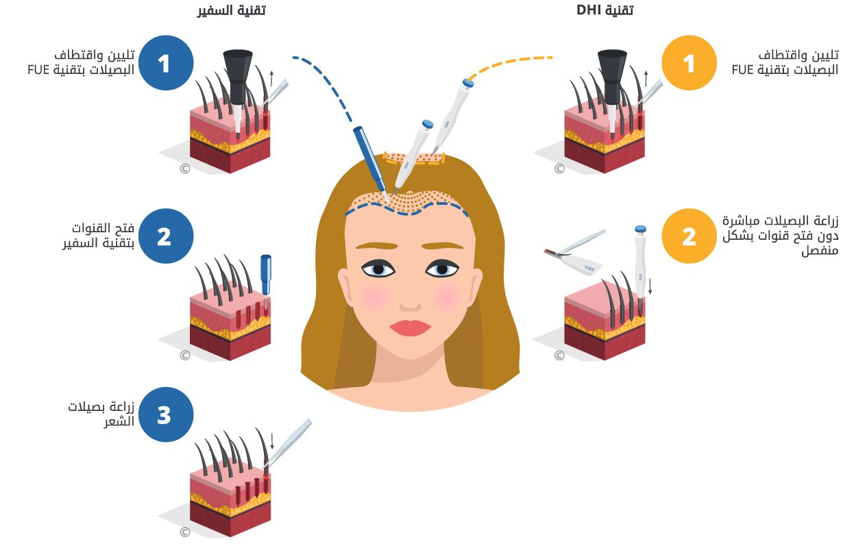 آلية تقنية sdhi لزراعة الشعر
