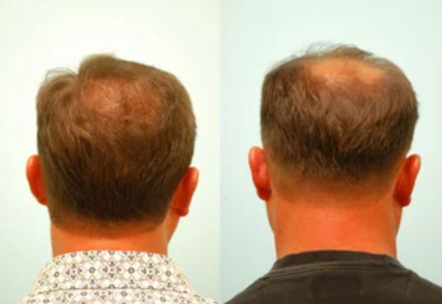 تجربة إعادة زراعة الشعر لأحد الرجال بعد فشل الأولى