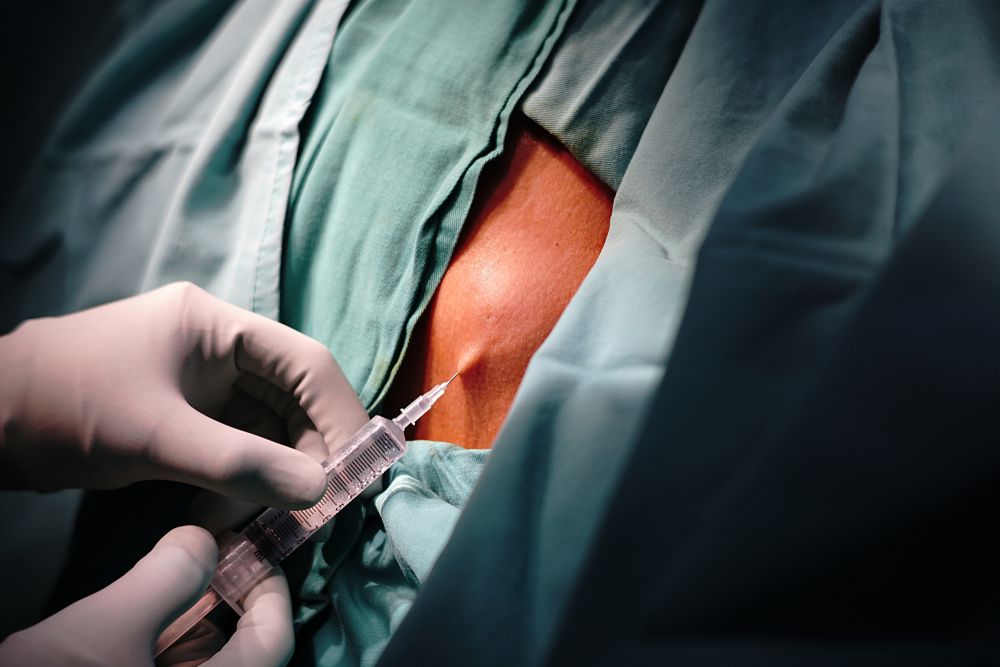 عملية ازالة الكيس الدهني من الراس بالجراحة