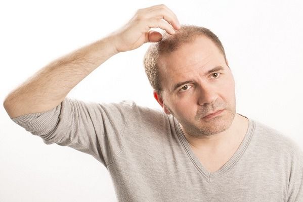 علاج تساقط الشعر الوراثي عند الرجال