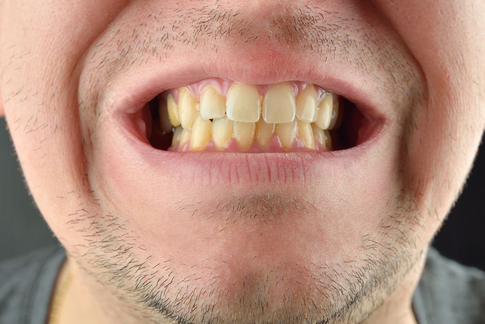 أسباب اصفرار الأسنان 