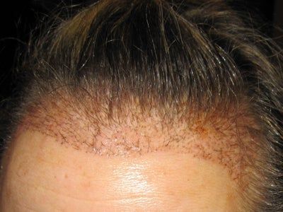 زراعة الشعر بالشريحة (FUT)