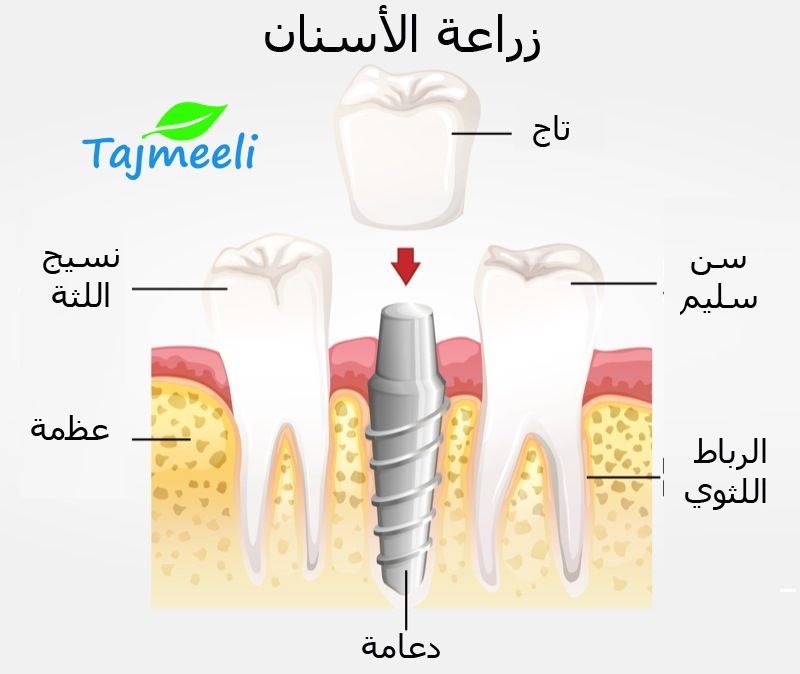عملية زراعة الأسنان التقليدية في اربيل