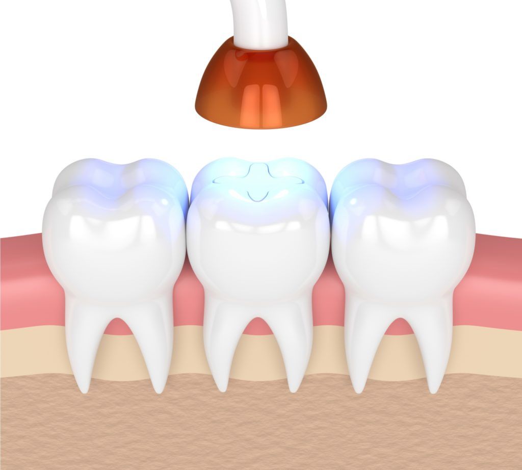 الحشوات الضوئية للأسنان 