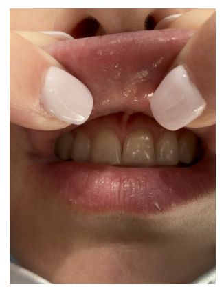 علاج فطريات الفم واللثة
