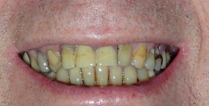 المشاكل التي يعالجها فينير الأسنان