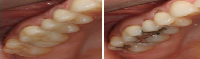 نتائج الليزر في حشو الاسنان وازالة التصبغات