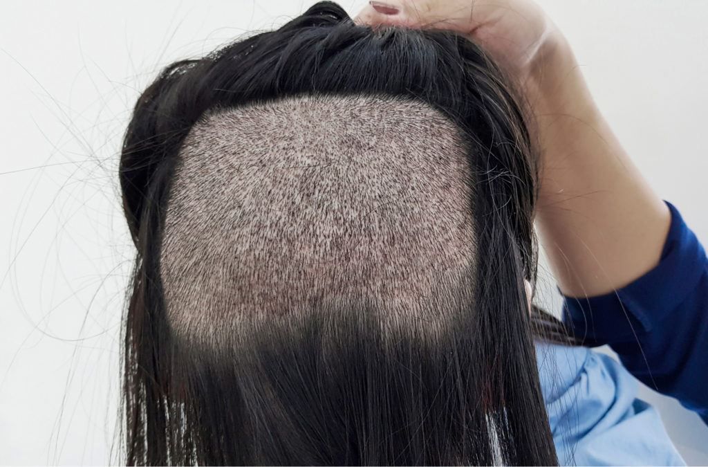 إجراءات عملية زراعة الشعر بدون حلاقة 