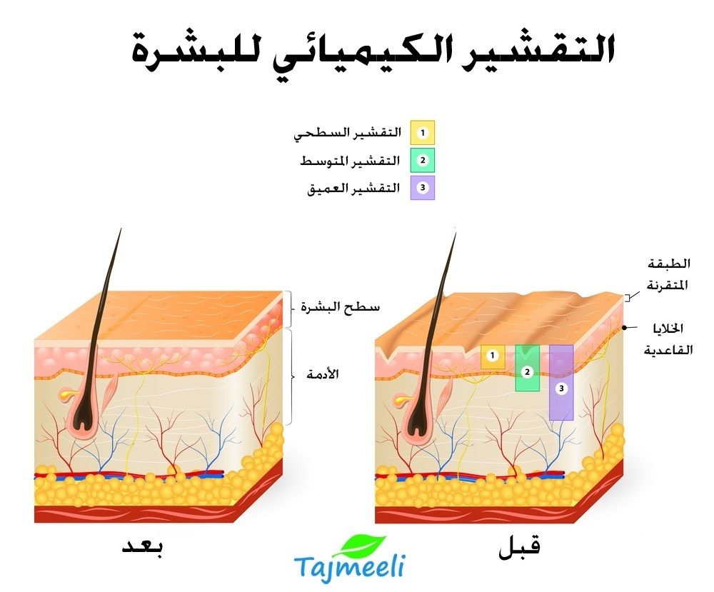الإجراءات التجميلية لإزالة الخطوط تحت العين التقشير الكيماوي
