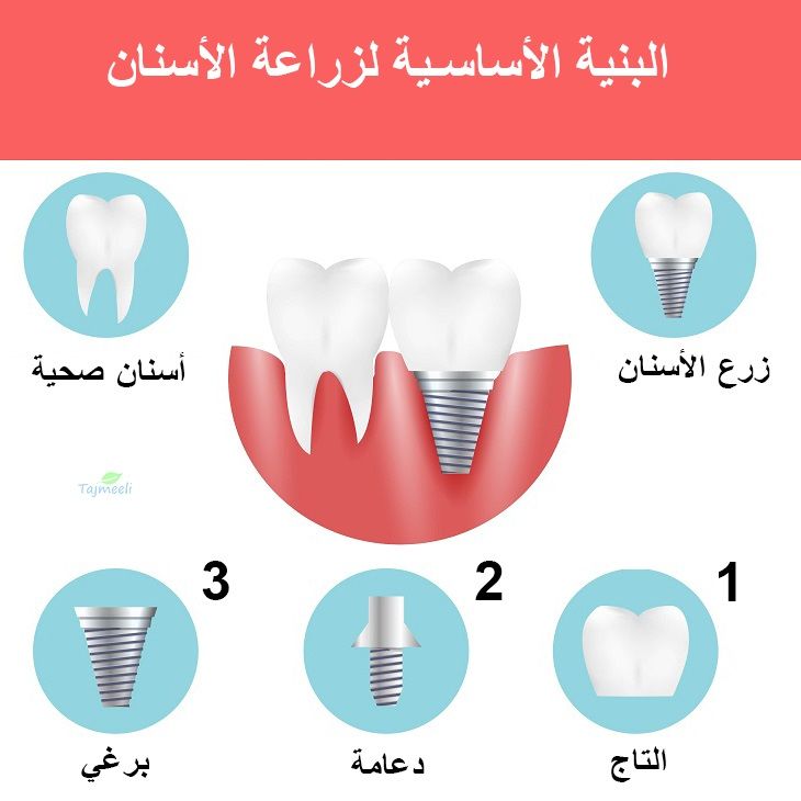 البنية الأساسية لزراعة الأسنان
