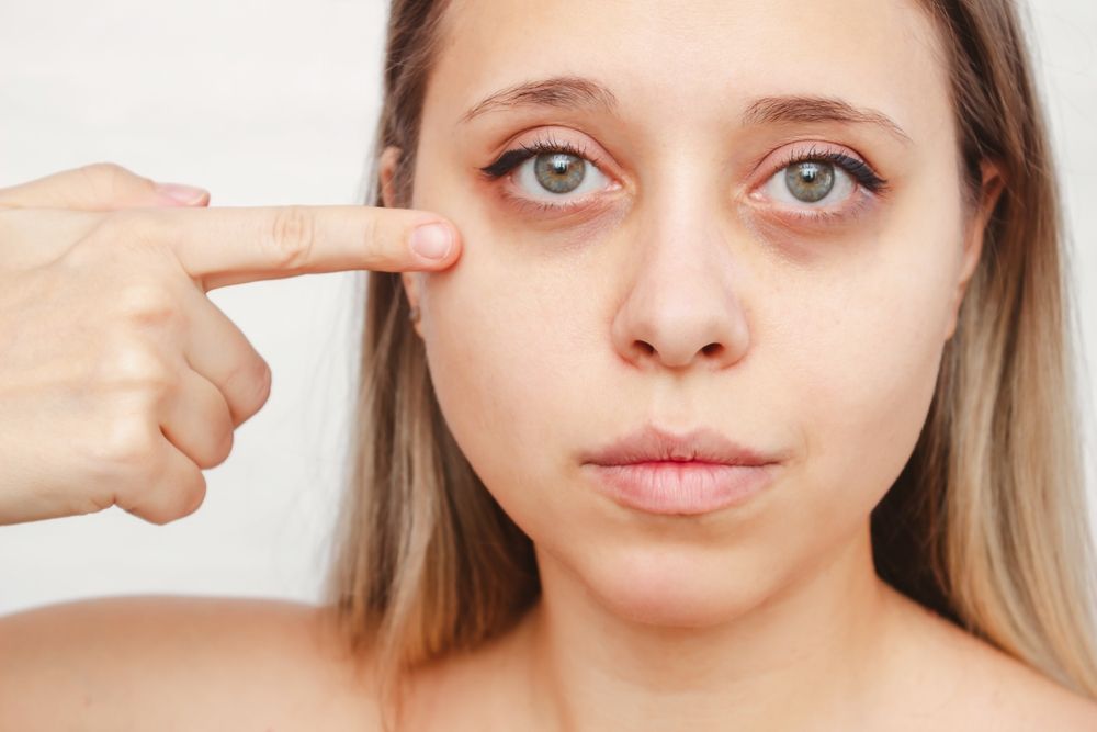 ما هي الآثار الجانبية المترتبة على حقن الفيلر تحت العين؟