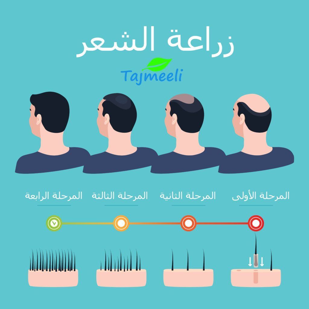 عمليات زرع الشعر في الكويت