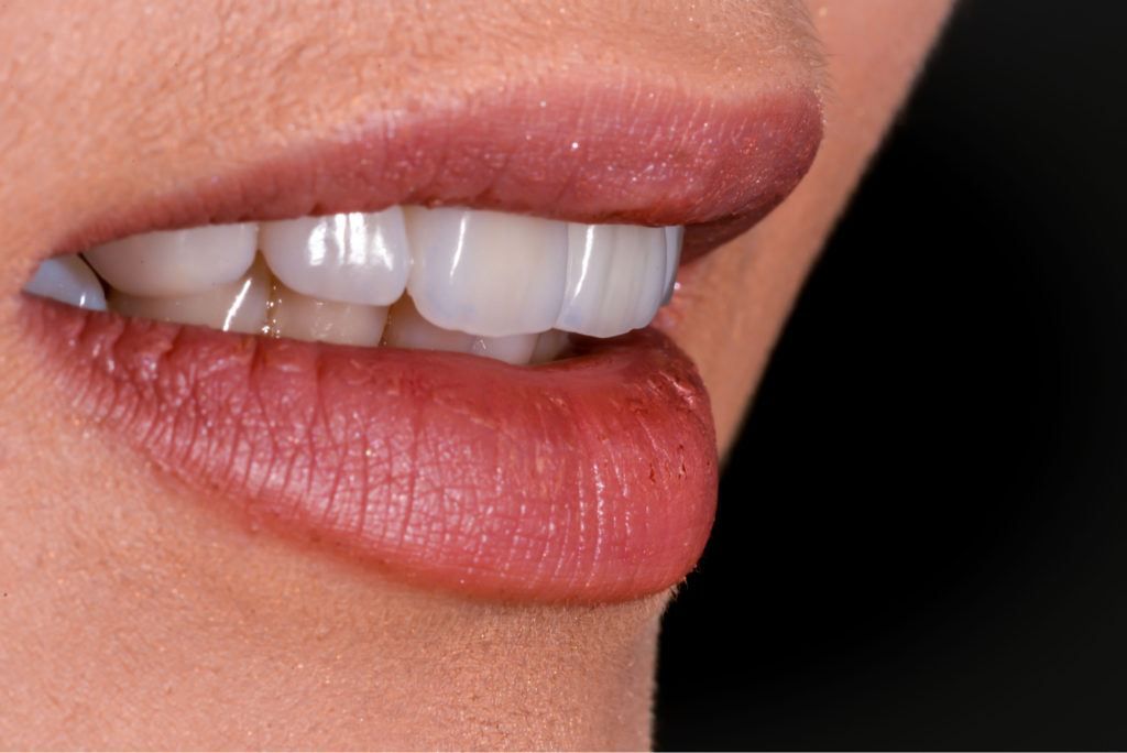 مميزات تركيب الاسنان الزيركون