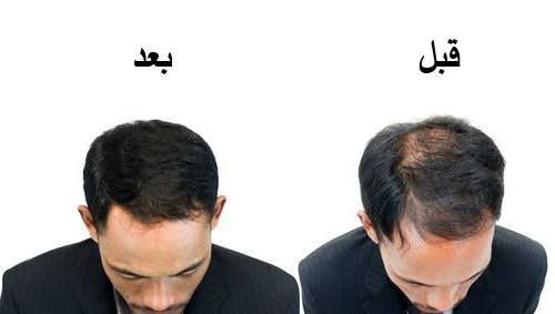 نتائج عمليات زراعة الشعر 