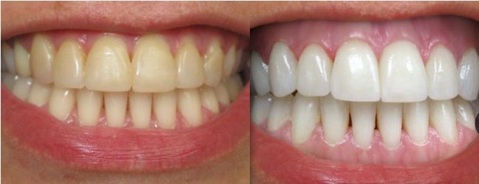 Advantages and Disadvantages of the Hollywood Smile in Abu Dhabi