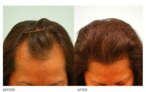 زراعة الشعر للنساء قبل وبعد