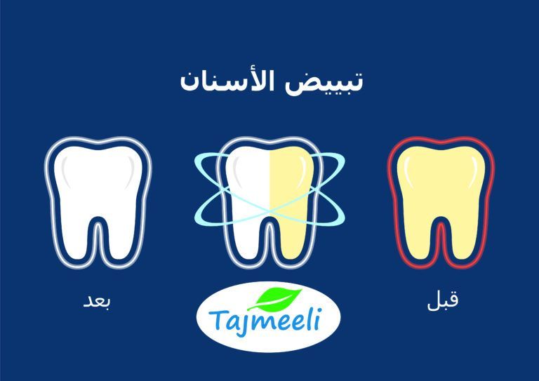 ما هو تبييض الأسنان بالليزر بالمغرب