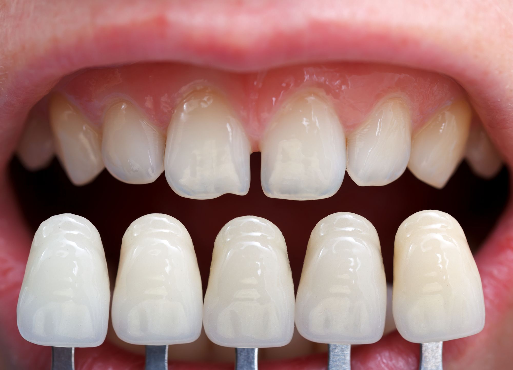 أنواع عدسات الأسنان