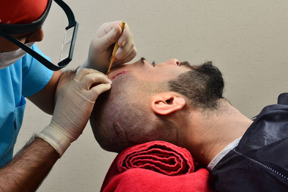 أطباء متخصصين في زراعة الشعر الطبيعي في المغرب