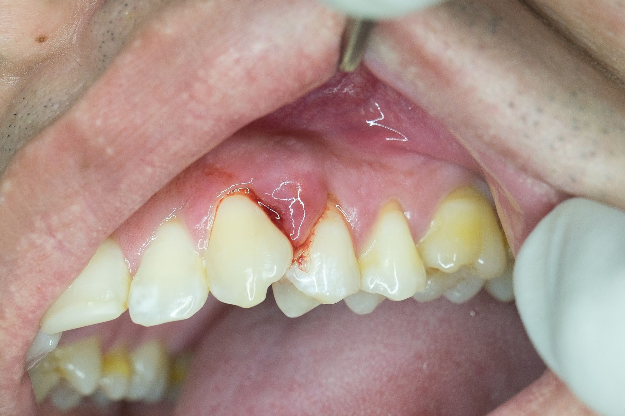 أسباب حدوث خراج الأسنان