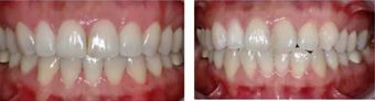 مدة شفاء خراج الأسنان بعد علاجه