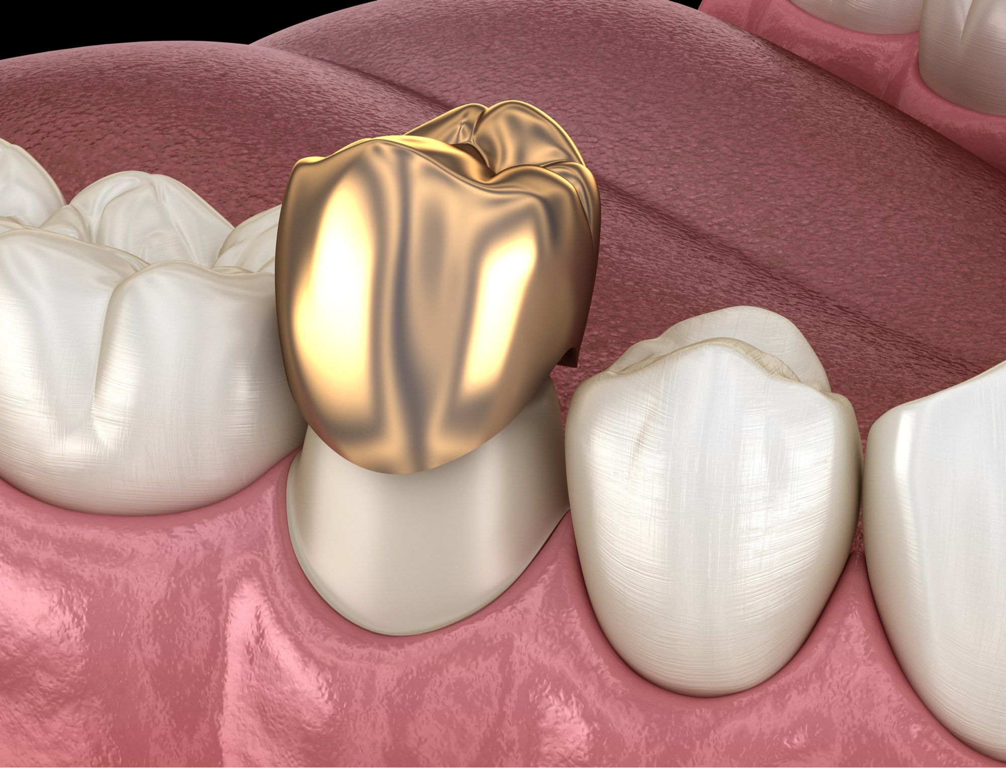ما هي عملية تركيب الأسنان الثابتة الأمامية بمصر؟