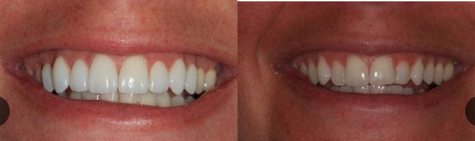 نتائج مرضية قبل وبعد تبييض الأسنان بالليزر