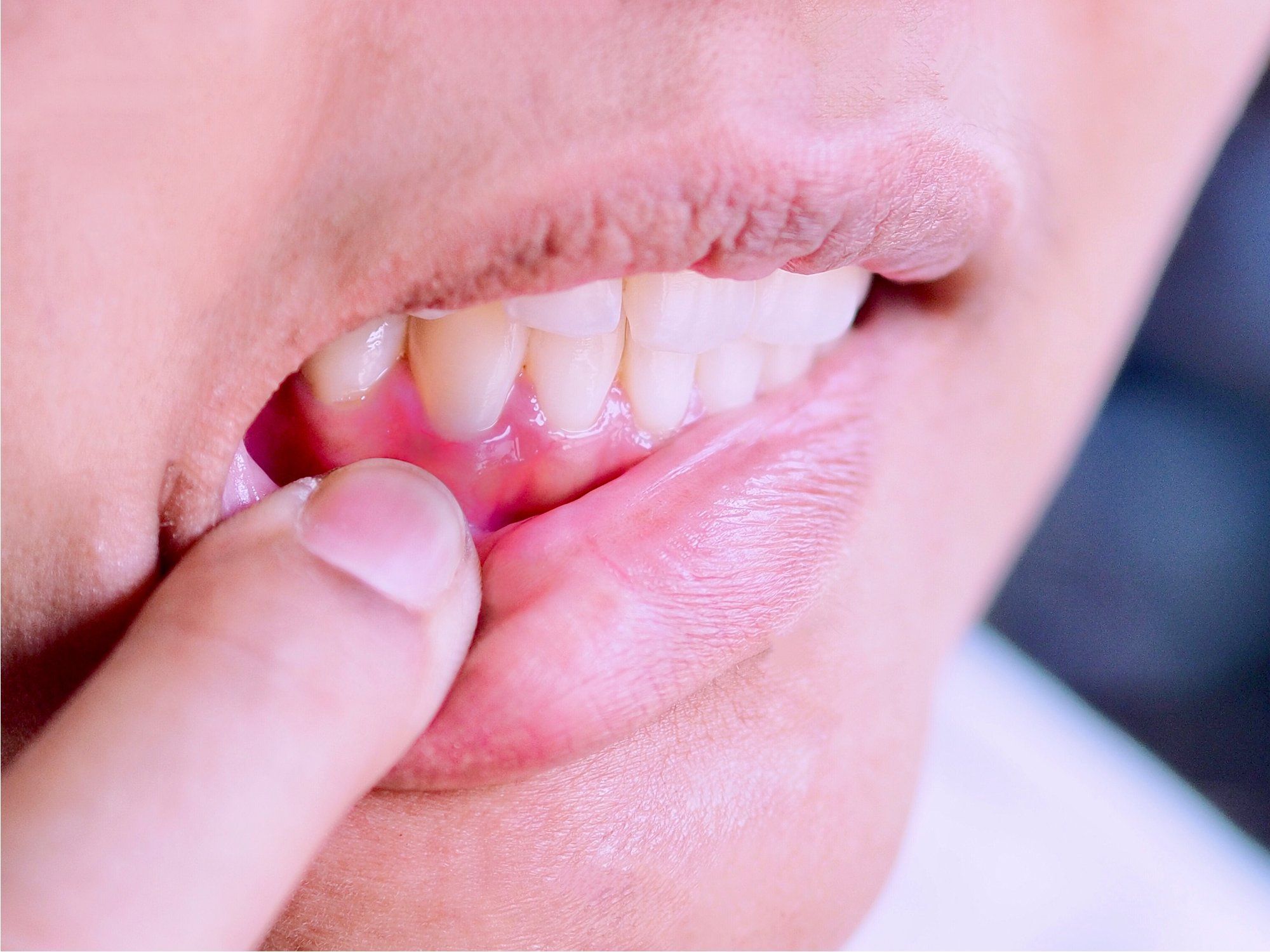 اضرار استخدام الليزر في تبييض الاسنان