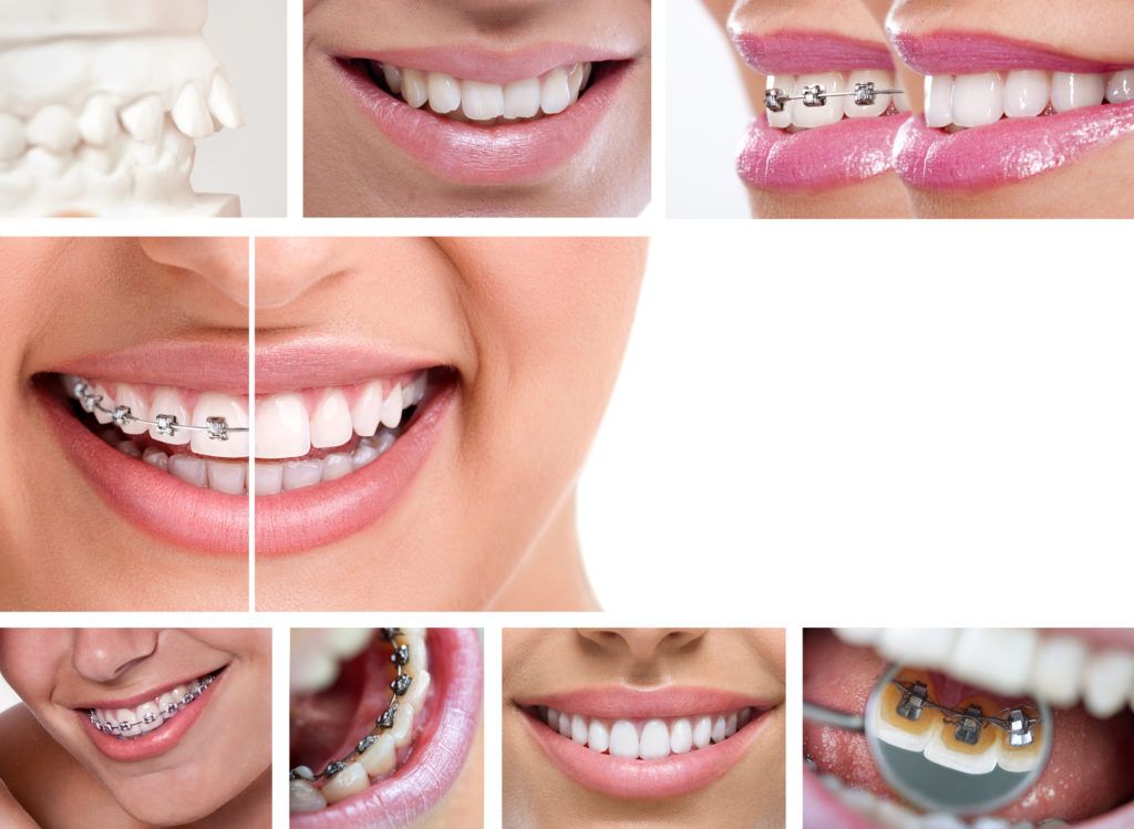 ما هي التقنيات المستخدمة في تعديل الأسنان