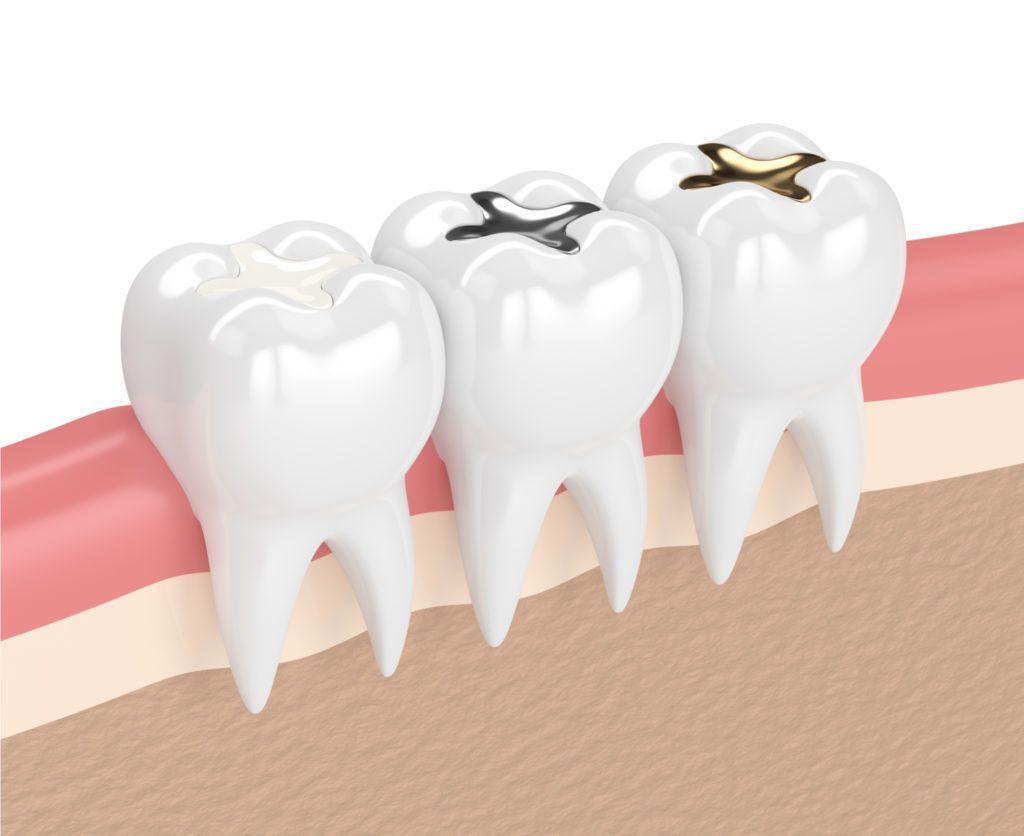 أنواع حشوات الأسنان  
