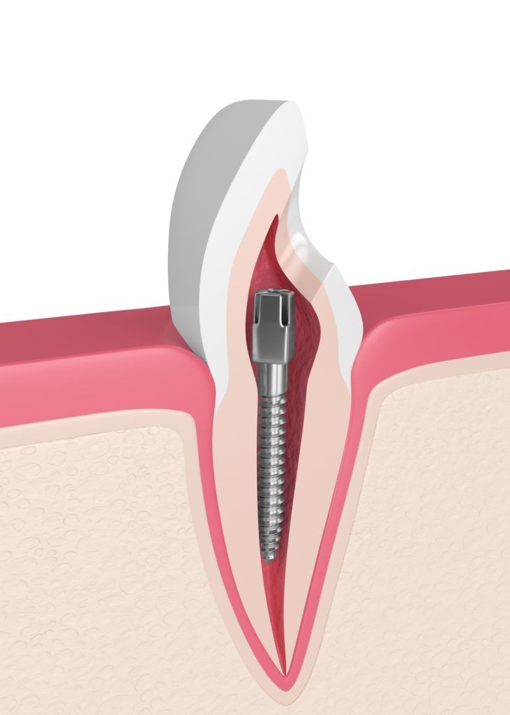 أجزاء دعامات الأسنان