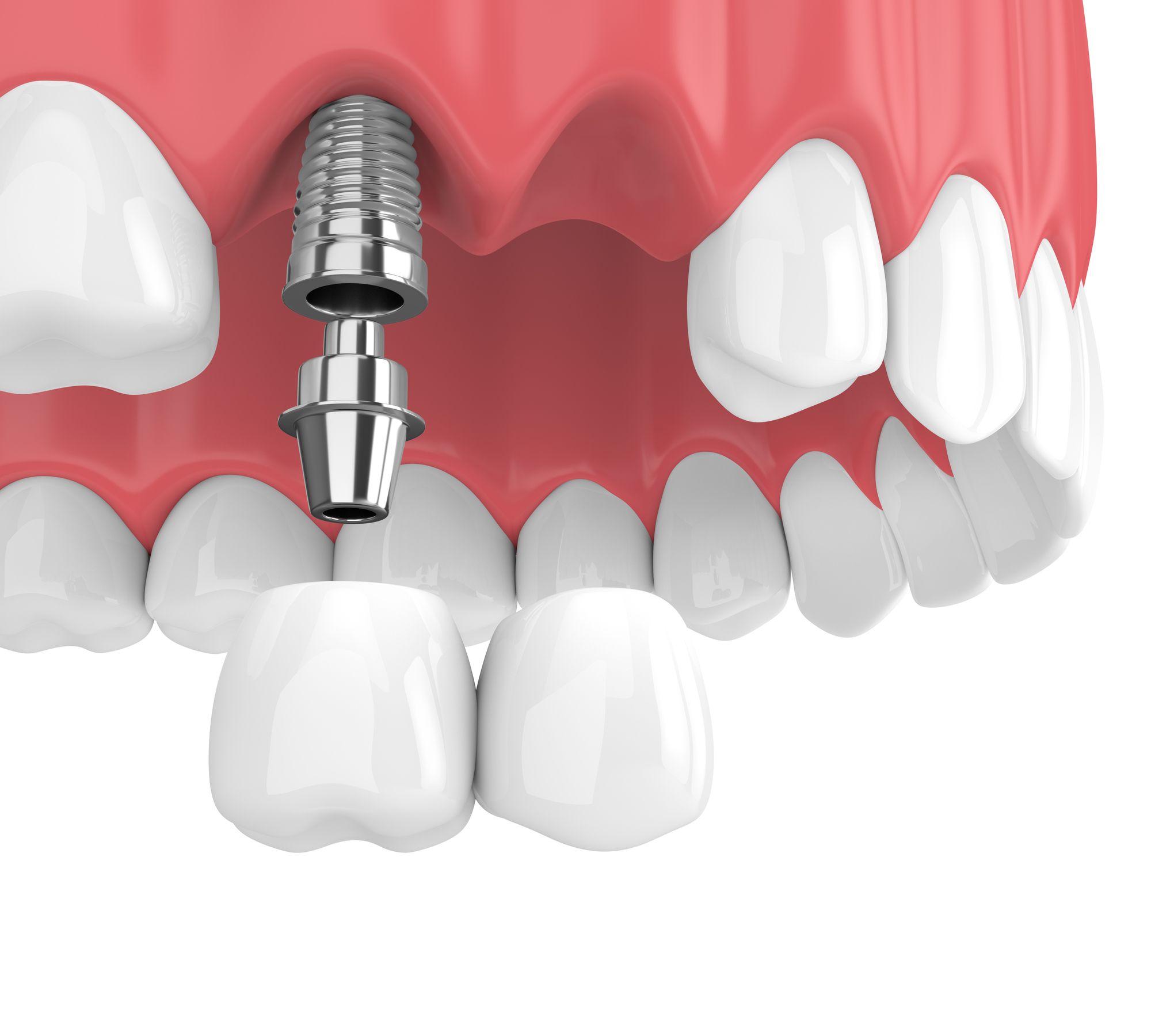 The Latest Dental Implant Techniques