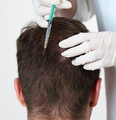 زرع الشعر بتقنية الخلايا الجذعية