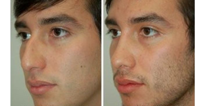 Advantages and Disadvantages of Rhinoplasty in the United Arab Emirates