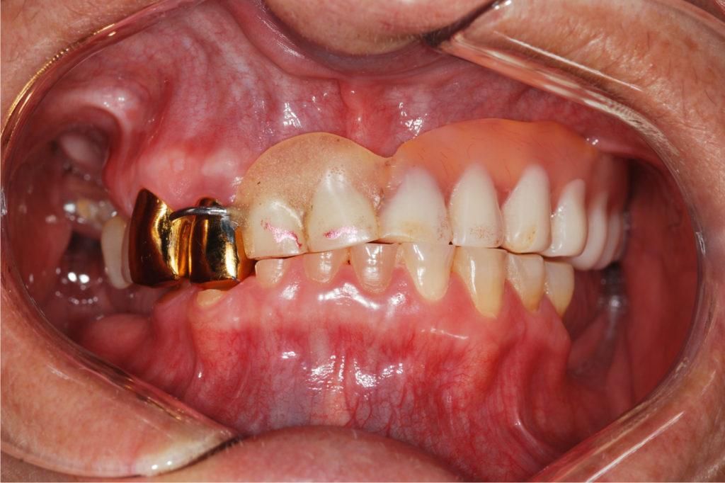 مميزات تركيبات الأسنان الثابتة