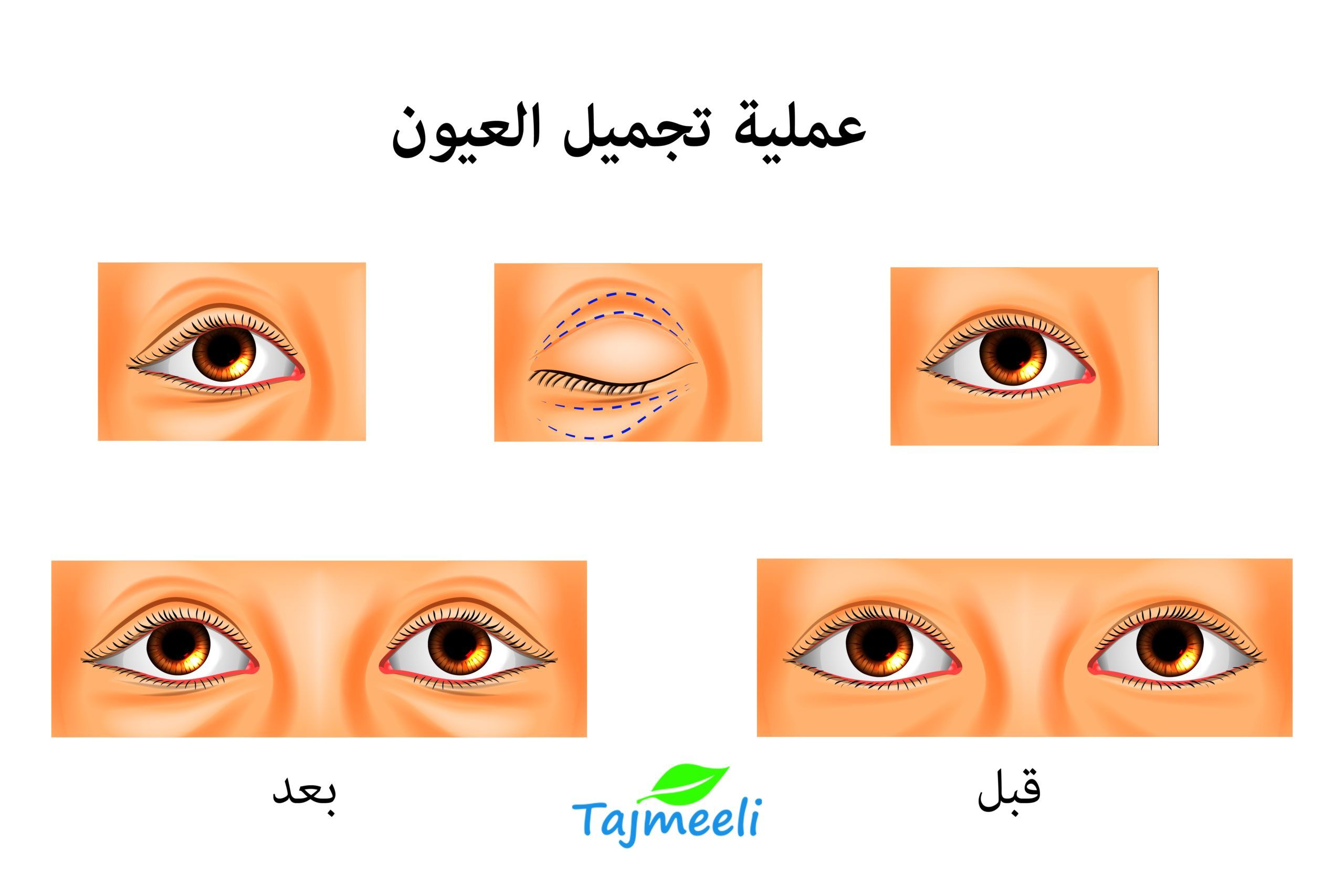 ما هي عملية تكبير وتوسيع العيون؟