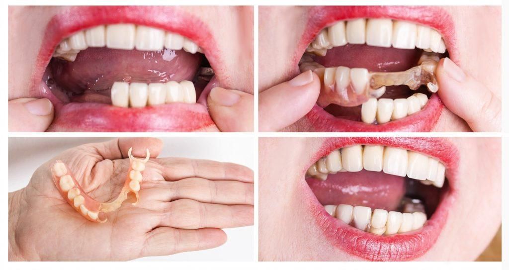 الآثار الجانبية لتركيبات الأسنان المتحركة