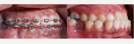 حالات تقويم الاسنان