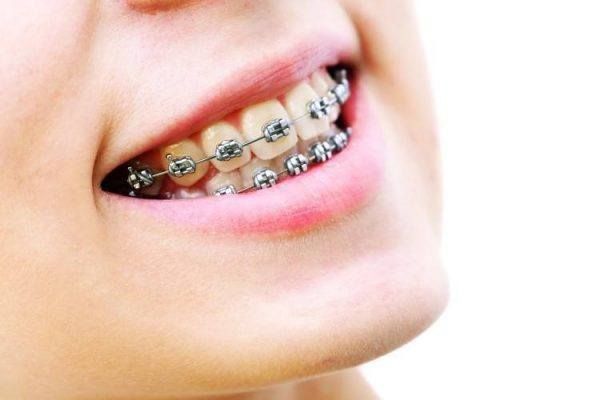 هل تركيب تقويم الاسنان مؤلم