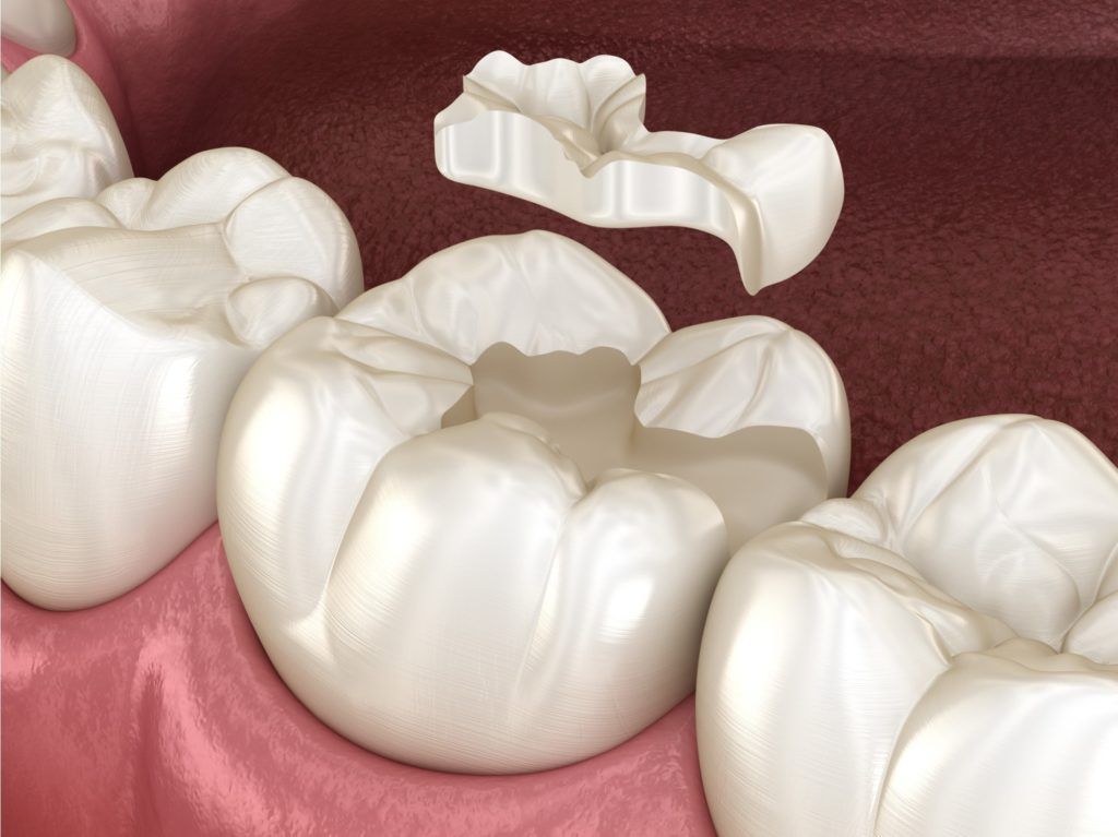 الحشوات المركبة المماثلة للون الأسنان